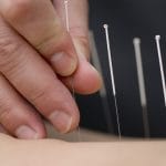 Treatment by acupuncture