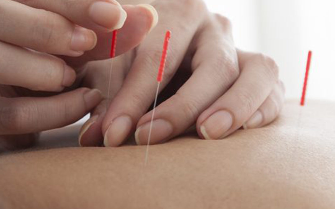 Acupuncture Benefits of acupuncture pain management