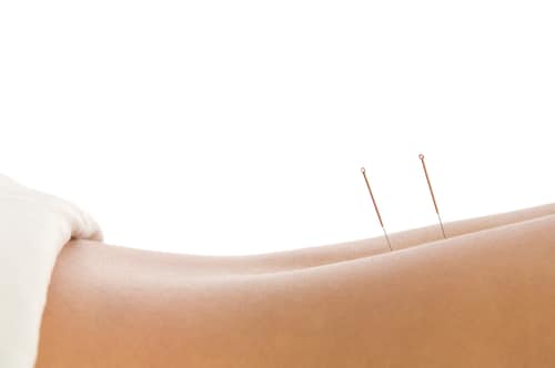 Acupuncture for Back Pain and Depression