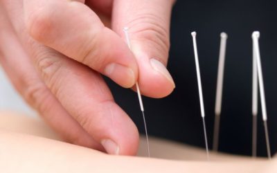 4 Conditions That Can Be Treated With Acupuncture